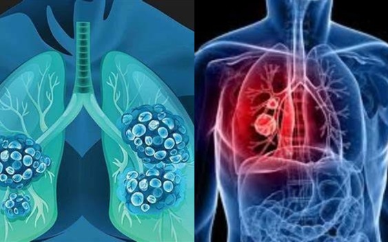 WHO khuyến cáo chỉ cần thay đổi một điều này, nguy cơ UNG THƯ có thể giảm mạnh: Gần 40% ca bệnh hoàn toàn có thể phòng tránh