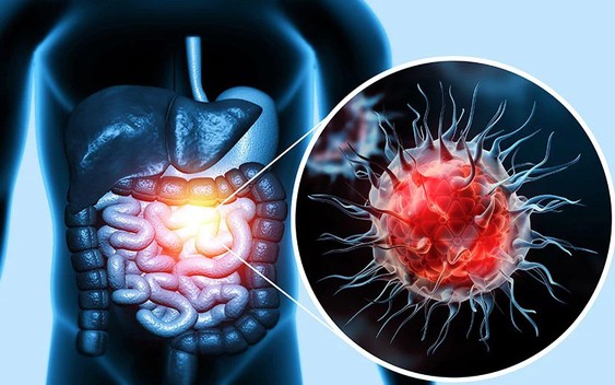 Ung thư đại trực tràng gia tăng đáng báo động: 4 dấu hiệu ở xa “tít tắp” có thể cảnh báo sớm