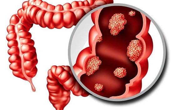 6 dấu hiệu cảnh báo đỏ của "căn bệnh ung thư đáng sợ": Có 1 cũng cần đi khám ngay!