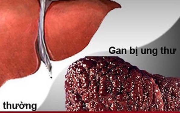 5 dấu hiệu cảnh báo ung thư gan sớm, mơ hồ cũng không nên bỏ qua