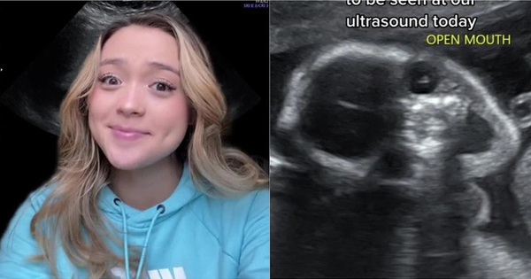 The weird baby ultrasound photo attracts 9 million views, but the truth revealed by the mother makes everyone’s heart warm
