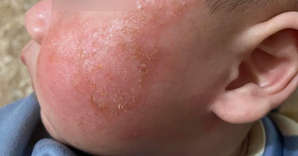 Abstinence from bathing children with Covid-19, the consequences of severe dermatitis: Doctor warns
