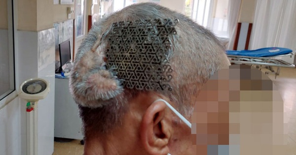 Man hospitalized with open titanium plate on skull