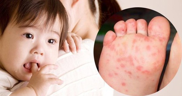 Things parents need to pay attention to when taking care of children with hand, foot and mouth disease