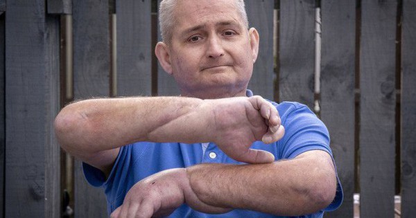 Man with scleroderma receives the world’s first double hand transplant in the UK
