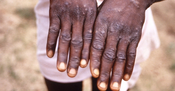 Difference between monkeypox and COVID