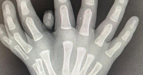 Boy has a rare 8-fingered hand