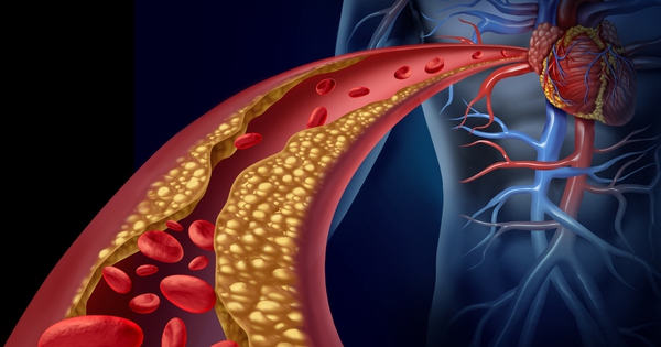 High blood fat – “silent killer” causing stroke: 4 groups of people are susceptible, number 1 is especially dangerous