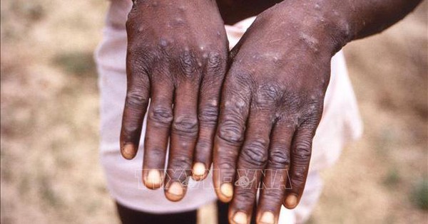 Over 1,000 cases of monkeypox outside Africa