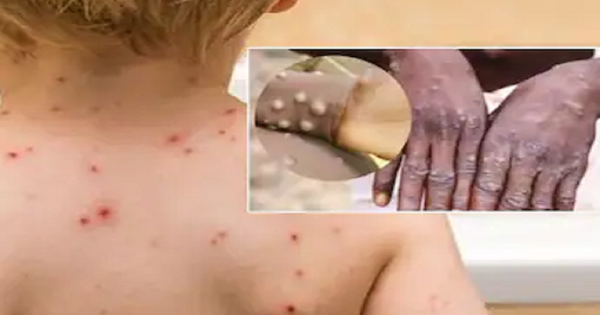 Difference between monkeypox and chickenpox
