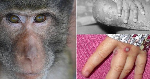 thumbnail - Nóng: Bộ Y tế ban hành hướng dẫn chẩn đoán, điều trị và phòng bệnh đậu mùa khỉ ở người
