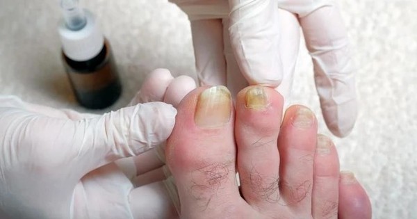 "Soi" chân bắt bệnh: 5 dấu hiệu cho thấy lá gan đang “kiệt sức”, nguy cơ UNG THƯ cận kề