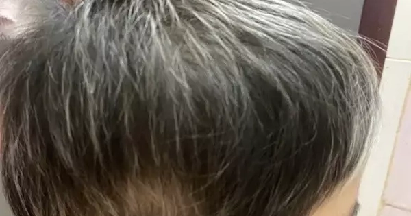 Điều trị thành công cho bệnh nhân 7 tuổi rụng toàn bộ tóc