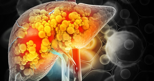 Cảnh báo kiểu ăn cực hại gan, "mời gọi" gan nhiễm mỡ: Nhiều người đang làm mỗi ngày