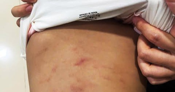 Vụ bé gái 2 tuổi ở Cà Mau bị bạo hành: Sau nửa tháng, bé vẫn hoảng loạn và sợ nơi đông người