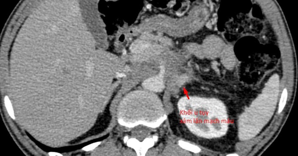 21 ngày 'bỏ đói' cơ thể, người đàn ông Hà Nội nhận kết quả khiến bác sĩ cảnh báo khẩn