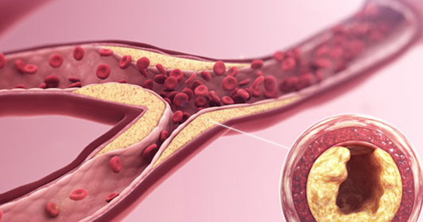 3 "kẻ thù" giấu mặt đang âm thầm bóp nghẹt mạch máu mỗi ngày, đột quỵ dễ ập đến bất ngờ