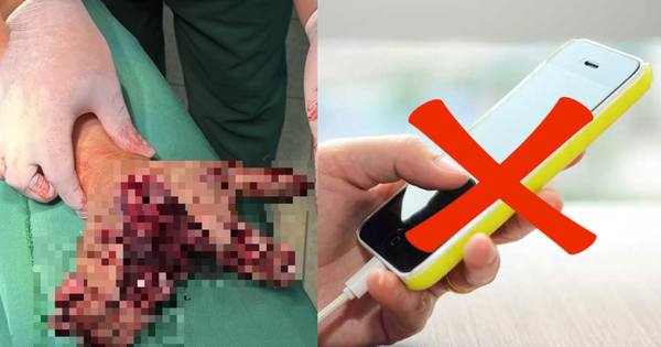 Vừa sạc pin vừa dùng điện thoại, người đàn ông Điện Biên bị chẻ đôi bàn tay