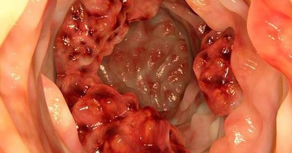 Bác sĩ cảnh báo 5 dấu hiệu ung thư đại trực tràng thường bị bỏ sót