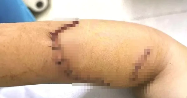 Sức khỏe nữ sinh lớp 9 bị bạn dùng dao tấn công gây đa thương tích ở Đắk Lắk