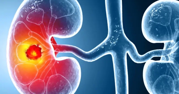 Số ca mắc ung thư thận gia tăng trên toàn cầu: Ở giai đoạn sớm hay muộn đều có 3 dấu hiệu này