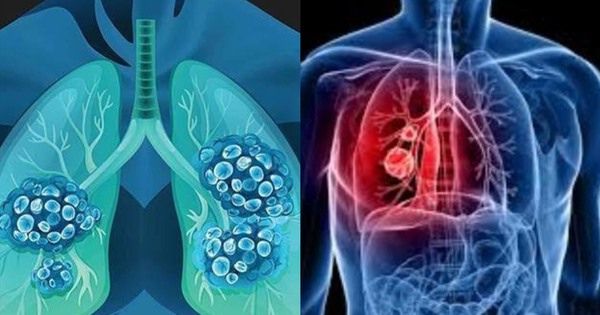 WHO khuyến cáo chỉ cần thay đổi một điều này, nguy cơ UNG THƯ có thể giảm mạnh: Gần 40% ca bệnh hoàn toàn có thể phòng tránh