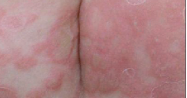 Bé trai 3 tuổi bị giang mai bẩm sinh dù không có triệu chứng