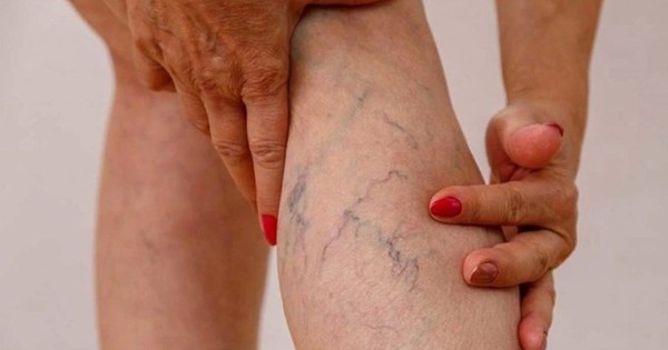 5 điều bác sĩ mạch máu nhắn nhủ bệnh nhân suy giãn tĩnh mạch ăn Tết vui khỏe, hạn chế gặp nhau trong bệnh viện