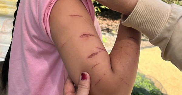 Chủ tịch UBND tỉnh Cà Màu chỉ đạo khẩn vụ nữ sinh lớp 5 bị gây thương tích