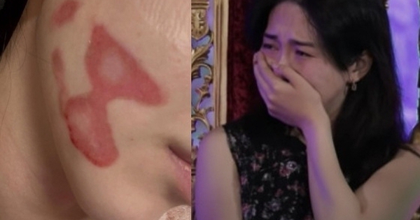 Nữ thần sắc đẹp showbiz bị bỏng mặt nghiêm trọng hậu thẩm mỹ, nhìn tình hình hiện tại mà xót thay