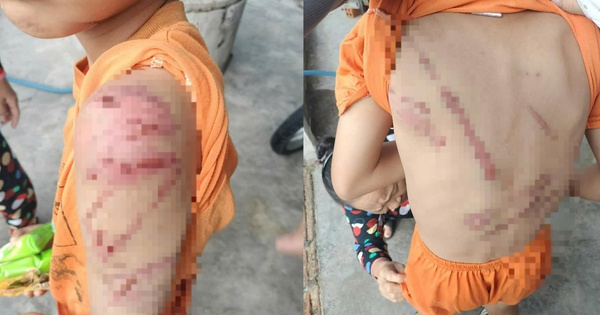 Xót xa hình ảnh cháu trai nghi bị cha đánh bầm tím khắp người