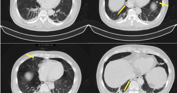 Người đàn ông phát hiện mắc hai bệnh ung thư cùng lúc