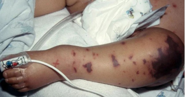 Liên tiếp ghi nhận ca mắc não mô cầu, nhận diện sớm dấu hiệu điển hình