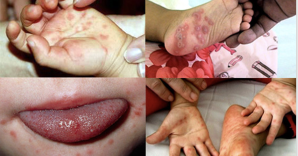 Sốt xuất huyết tăng 2,2 lần, tay chân miệng gấp 5 lần