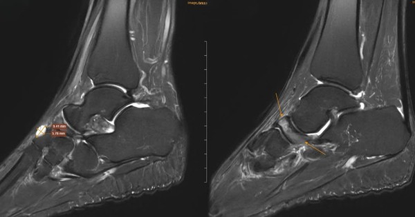4 thói quen âm thầm “ăn mòn” xương ở người trên 40 tuổi