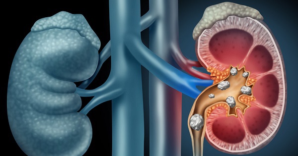 Nhiều người Việt phải cắt bỏ thận chỉ vì tự ý dùng 1 thứ tưởng là 