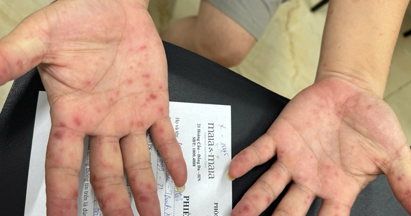 Số ca tay chân miệng tăng mạnh, cảnh báo nguồn lây từ tay nắm cửa, đồ chơi