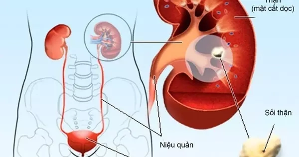 Cách phòng ngừa sỏi thận không dùng thuốc
