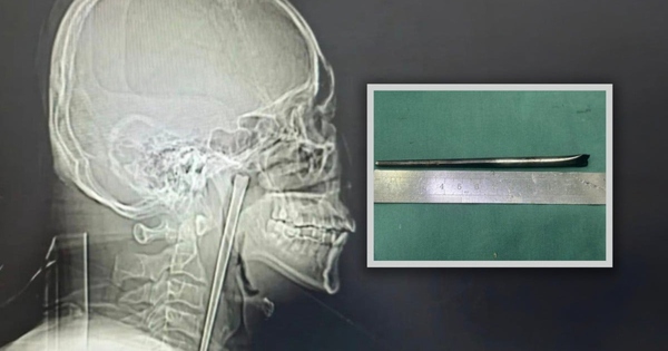 Người đàn ông sống 8 năm với chiếc đũa trong cổ họng và cái kết khiến cộng đồng mạng không thể tin nổi