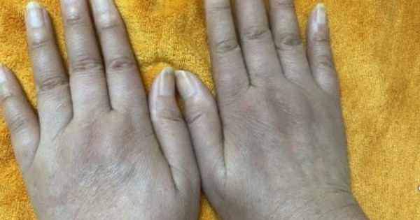 Nữ doanh nhân có 1 dấu hiệu lạ ở tay nhiều năm: Đi khám bác sĩ cảnh báo hàng loạt tạng đang "gặp nguy"
