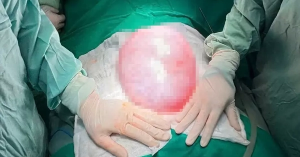 Phát hiện khối u gần 4kg trong bụng bé gái 13 tuổi