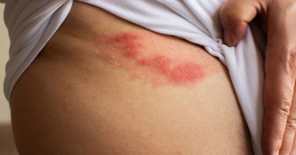 Bị giời leo bôi thuốc gì cho nhanh khỏi?