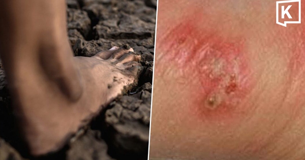 Thái Lan cảnh báo khẩn về dịch 