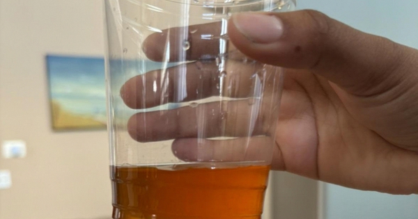 Ngày càng có nhiều người tử vong vì ung thư tuyến tụy, bác sĩ nhắc: Đừng xem nhẹ 3 thứ khi đi vệ sinh!