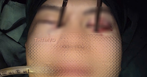 Hy hữu: Nam thanh niên 25 tuổi bị 2 chiếc đũa đâm thẳng vào 2 mắt cùng lúc