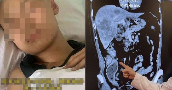 Thiếu niên 18 tuổi mắc ung thư đại trực tràng giai đoạn 3, bác sĩ nhắc: Người trẻ thường bỏ qua 2 dấu hiệu cảnh báo