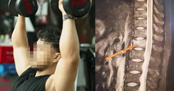 Người đàn ông 34 tuổi xương giòn như bà cụ 60 tuổi vì ngày nào cũng uống 3 cốc loại nước nhiều người không thể sống thiếu