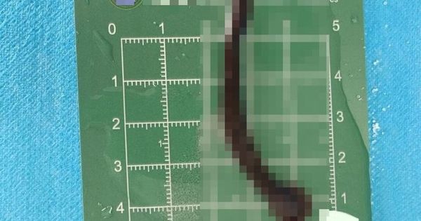 Bé trai 8 tuổi ho ra máu suốt 10 ngày, bác sĩ gắp được 