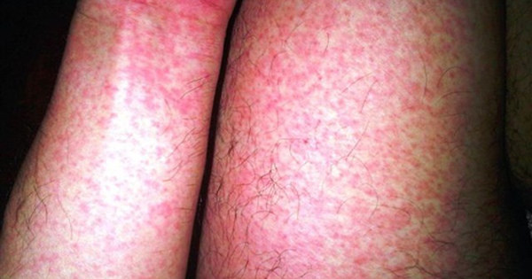 Gần 32.000 ca mắc, 4 ca tử vong: Bệnh viện Bạch Mai phát cảnh báo về 1 căn bệnh đang tăng nhanh, có thể suy đa tạng chỉ trong vài ngày