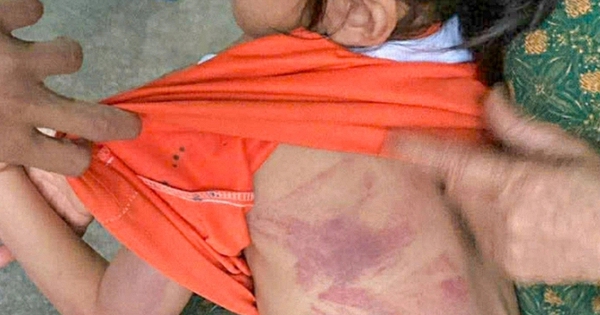 Tôi bàng hoàng khi xem bức ảnh bé gái mầm non bị bạn nam cùng lớp đánh bầm lưng: Hỏi thật, một lời xin lỗi liệu có đủ?